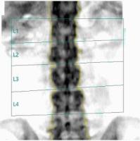 AP-Spine-Fracture-POC project thumbnail