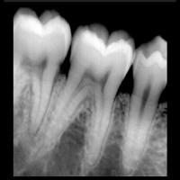 periapical xray errors project thumbnail