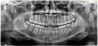 Dilaceration - Rishal project thumbnail