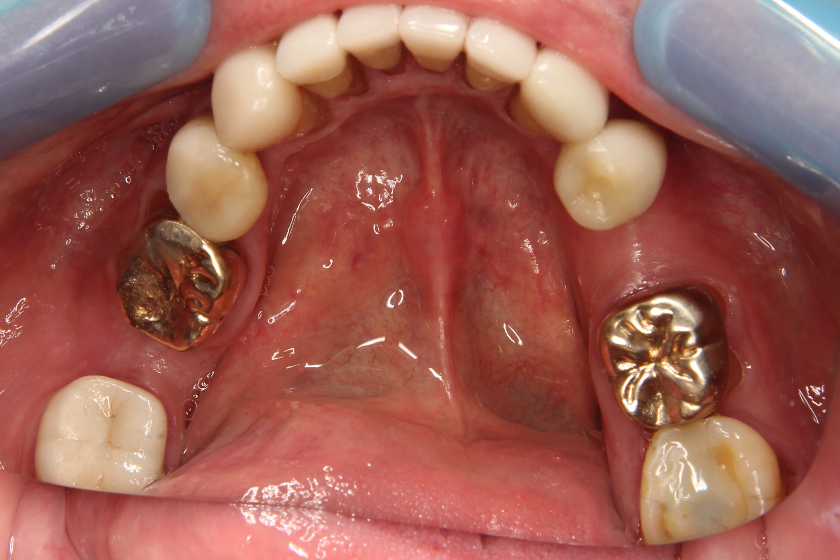 5block_lower Object Detection Model by DentalMate6v