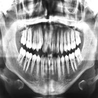 teeth (teeth-bu3w7) - Roboflow Universe