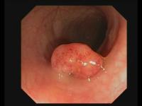 Colonoscopy project thumbnail
