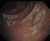 colonoscopy image project thumbnail