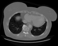 lung cancer detection Project project thumbnail