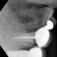 Bone loss Detection project thumbnail