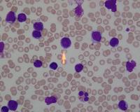 Leukemia cells prediction project thumbnail