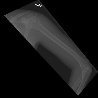 bone fracture Object Detection Dataset by Dhruti