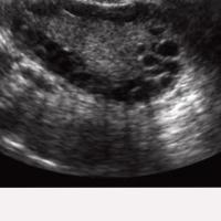 pcosdetection project thumbnail