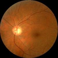 eye disease project thumbnail
