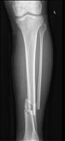 fractured bone detection project thumbnail