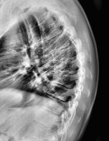 Find thoracic spine and thoracic scoliosis project thumbnail