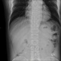 lable Thoracic Spine project thumbnail