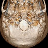 Object detection CT foramen project thumbnail