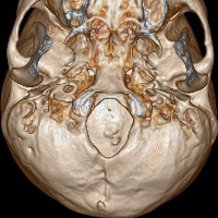 2 classification-ct-foramen project thumbnail