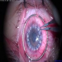 Microsurgery project thumbnail