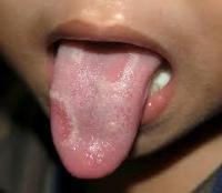 Tongue shape Object Detection Model by Tongue diseases