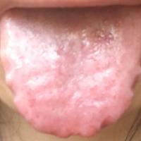 Tongue shape Object Detection Model by Tongue diseases