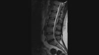 sagittal/l5-s1 project thumbnail