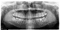 Impaction Classifier project thumbnail