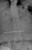 X ray project thumbnail