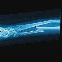 fracture Bones Detection project thumbnail