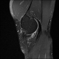 Femur-Tibia-Patella project thumbnail