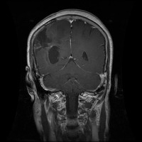 Brain Tumor project thumbnail