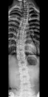 scoliosis project thumbnail