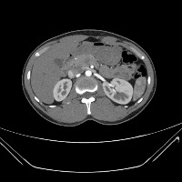 Kidney Normal project thumbnail
