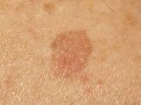 Lesions project thumbnail