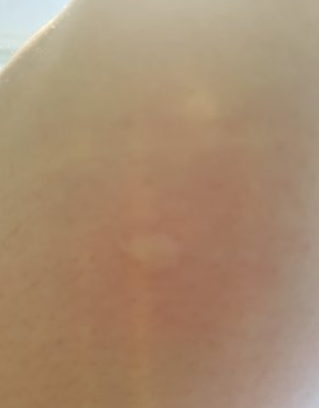 bug bites - Roboflow Universe