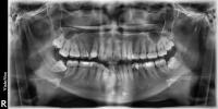 Dental Disease Detection project thumbnail