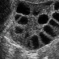 PCOS image classification project thumbnail