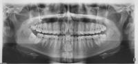 Annotate teeth project thumbnail