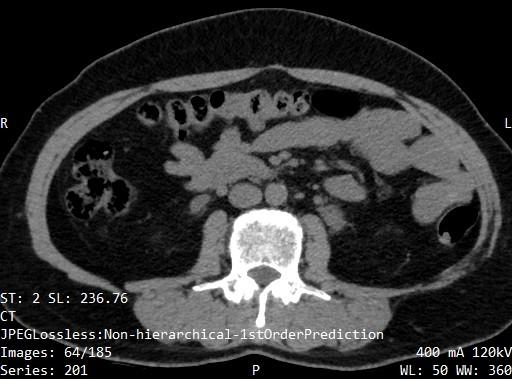 Kidney Tumor Detection Instance Segmentation Dataset By Imran Riaz Chohan Kidney Tumor Detection Instance Segmentation Dataset By Imran Riaz Chohan