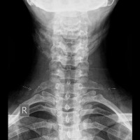 Cervical project thumbnail