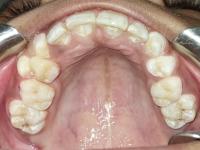 Maxillary project thumbnail