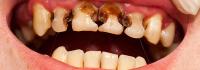 Dental Caries Detection project thumbnail
