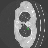 Lung Cancer Segmentation Instance Segmentation Model by Computer Vision ...