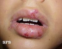skin diseases project thumbnail