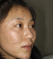 acne project thumbnail