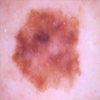 Skin Cancer project thumbnail