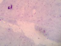 malaria project thumbnail
