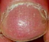 nail_pitting project thumbnail