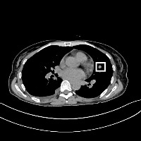 Lung project thumbnail