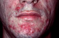 Acne ful project thumbnail