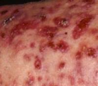 Acne detection project thumbnail