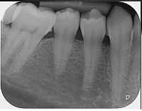 tooth project thumbnail
