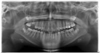 teeth_detect project thumbnail