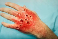 chronicwound 500 project thumbnail